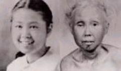 Werner's syndrome patient age 14, then age 48